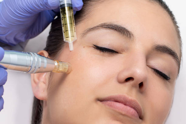 How Does Microneedling Treatment Minimize Visible Pores?