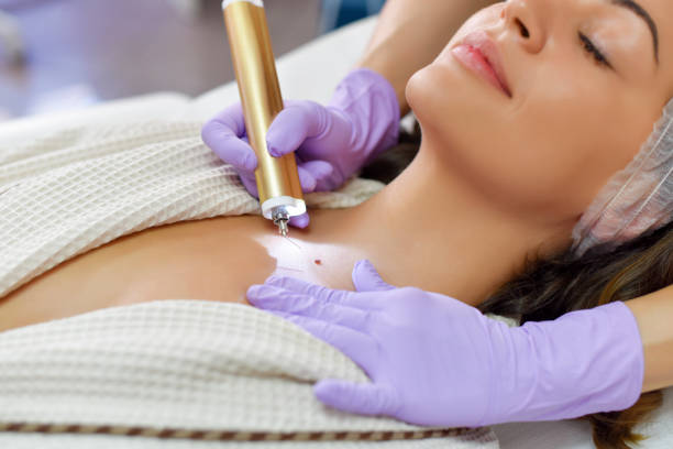 How Does Skin Lesion Removal Support a Clearer Skin Texture