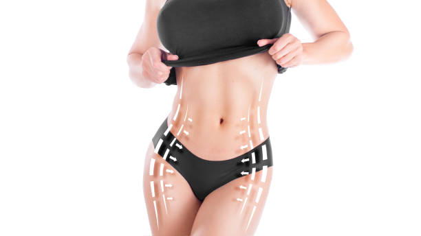 How quickly can Laser Liposuction show visible results