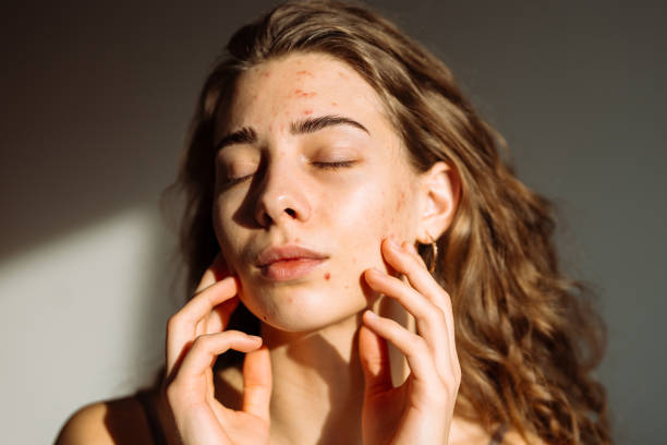 Is Acne Treatment Helpful for Recurring Acne?