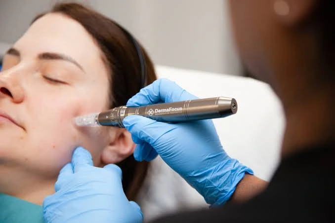 Is Exosomes Therapy Suitable for Fine Lines