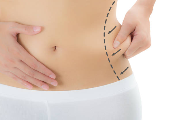 Is Lower Body Lift suitable for stable-weight adults