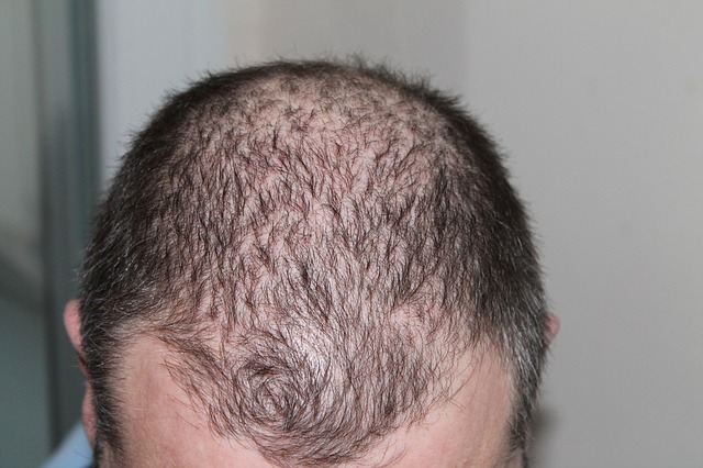 Scalp Micropigmentation Abu Dhabi