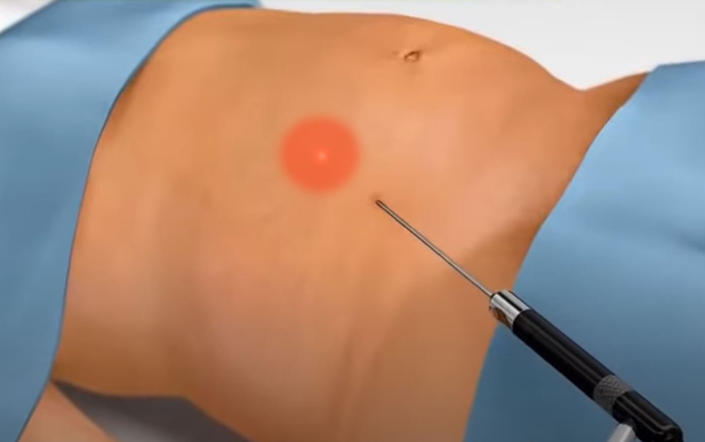 Laser Liposuction