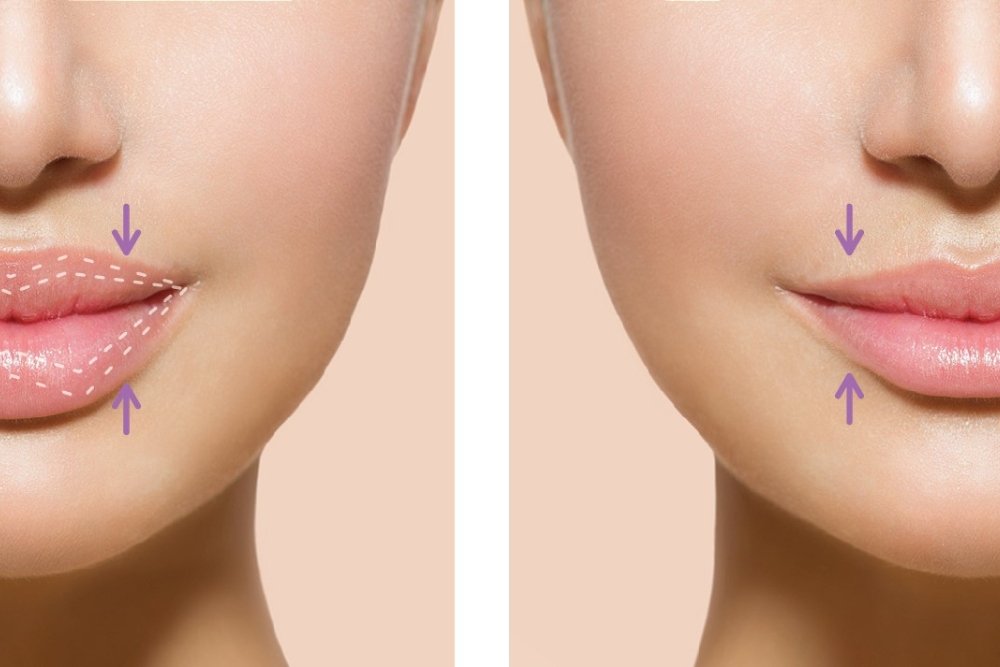 Lip Reduction