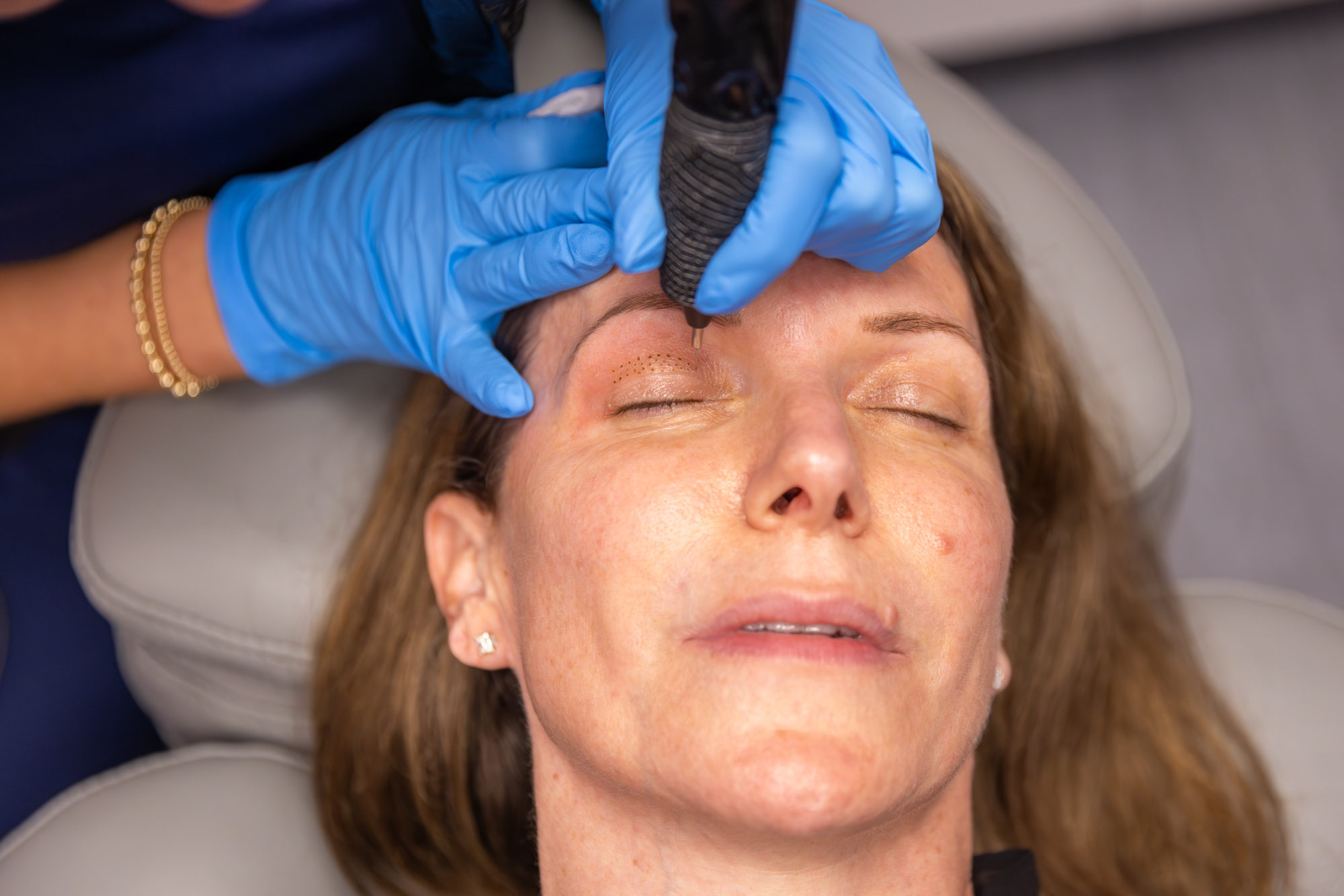 Top Clinics Setting Standards for Plasma Pen Treatment in Dubai