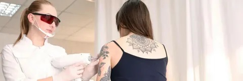 Tattoo removal in Islamabad