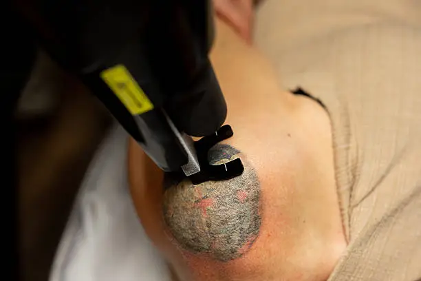 What Can Laser Tattoo Removal Do for Dark Ink?