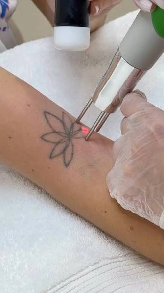 What Can Laser Tattoo Removal Treat Besides Ink
