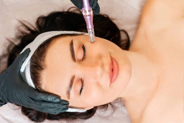 What Makes Microneedling Treatment Useful for Skin?