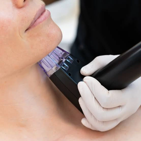 What Makes Morpheus8 Treatment In So Popular