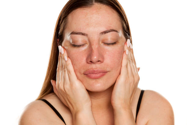 What Skin Changes Can Melasma Treatment Improve