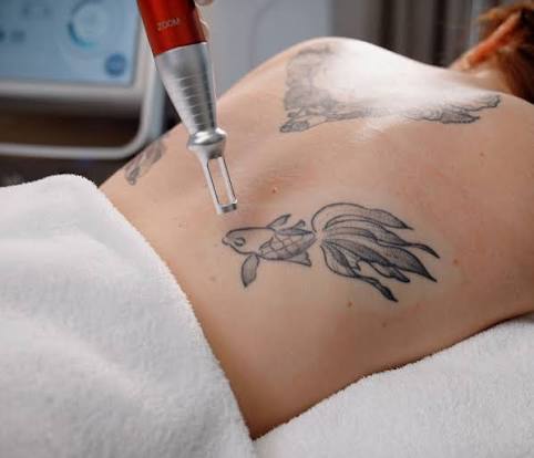 What factors affect Laser tattoo removal results and timing?
