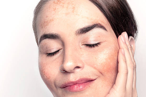 What factors affect the results of Pigmentation treatment?
