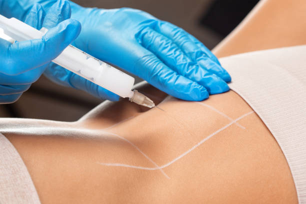 What should you know about Fat Dissolving injections?