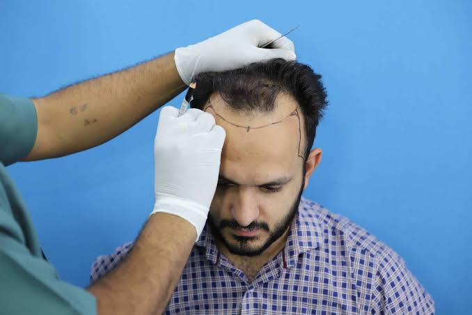 What should you know before a FUE hair transplant?