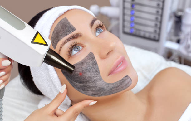 What skin concerns can Laser Carbon Peel address?