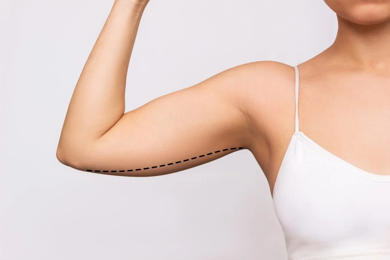 Why Our Arm Lift Surgery Approach Is Different