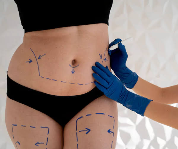 Why Does Liposuction Uae Need Consultation First?
