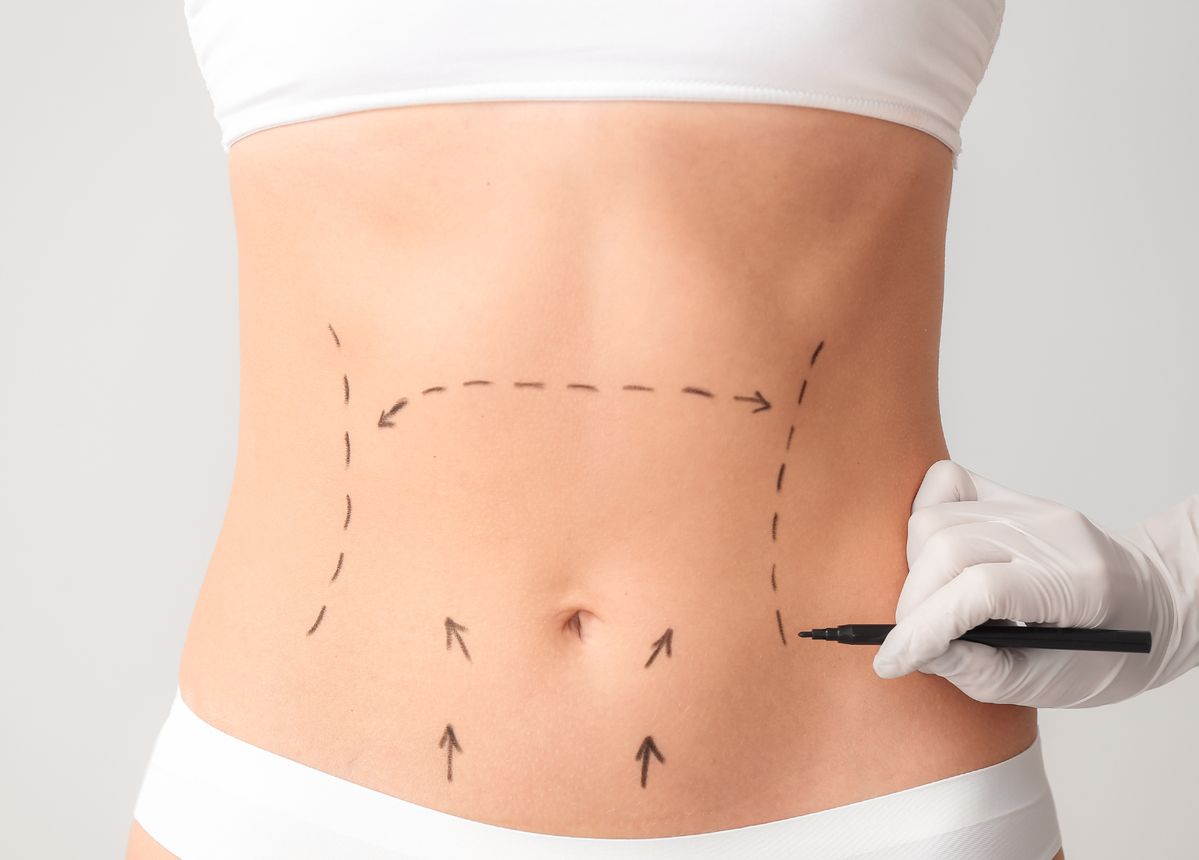 liposuction in islamabad