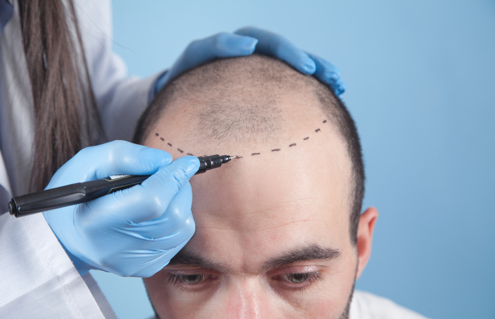 Choosing Grafts for Natural Hair Transplant in Dubai