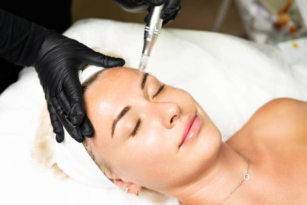 Can Fractional RF Micro Needling Improve Skin Texture