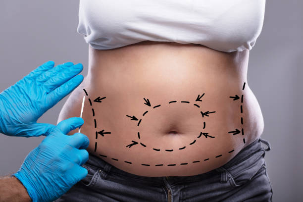 Can Laser Liposuction Target Stubborn Flank Fat Safely