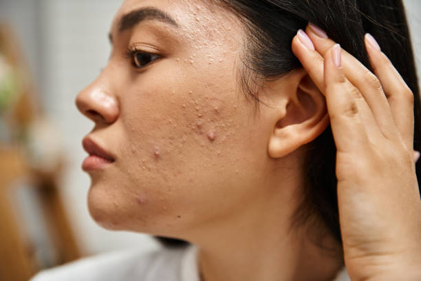 Does Acne Treatment Help With Excess Oil