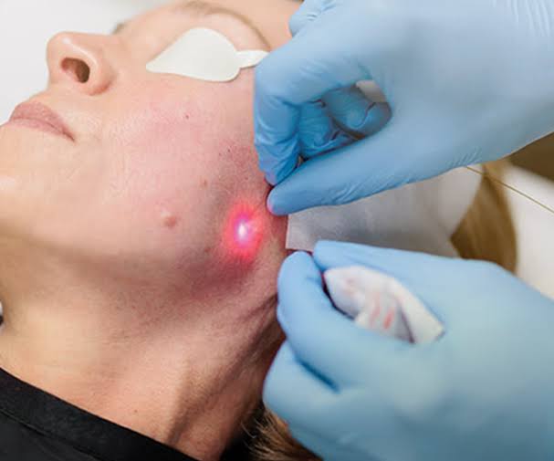Does Endolift Help Reduce Double Chin