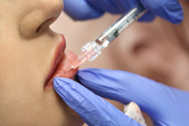 How Do Lip Fillers Add Natural Volume