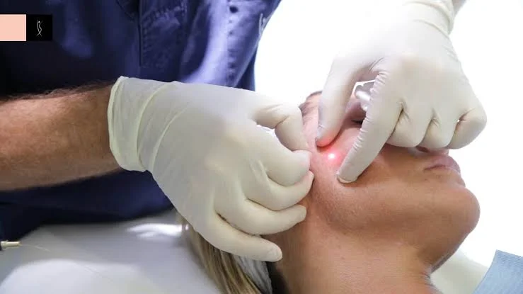 How Does Endolift in Improve Face Shape