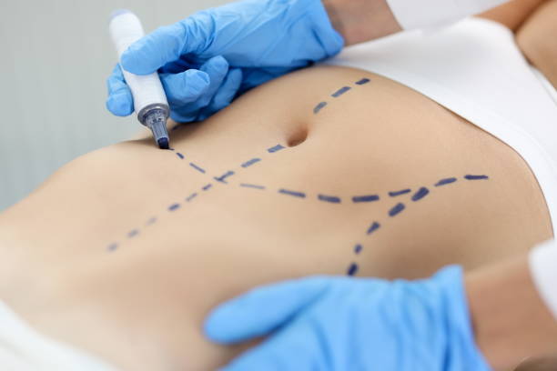 How can Tummy Tuck Surgery restore a flatter stomach