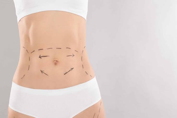 How can recovery be managed after Mini Abdominoplasty?