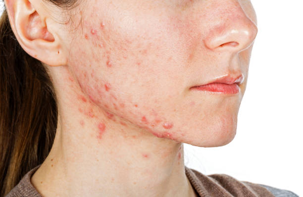 Is Acne Treatment Suitable for Sensitive Skin Types