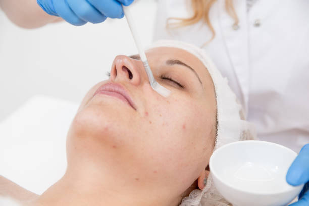 Is Chemical Peels treatment helpful for acne-prone skin