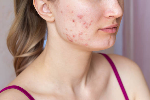 Is Laser Acne Scar Treatment the right option for you
