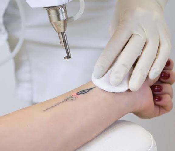 Is Laser Tattoo Removal Suitable for All Skin