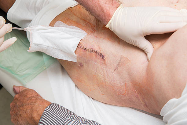 Is Skin Lesion Removal suitable for common skin growths