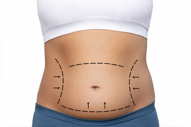 Is Tummy Tuck Surgery suitable after massive weight loss