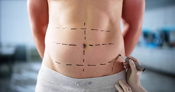 Is Tummy Tuck effective for improving abdominal contours?