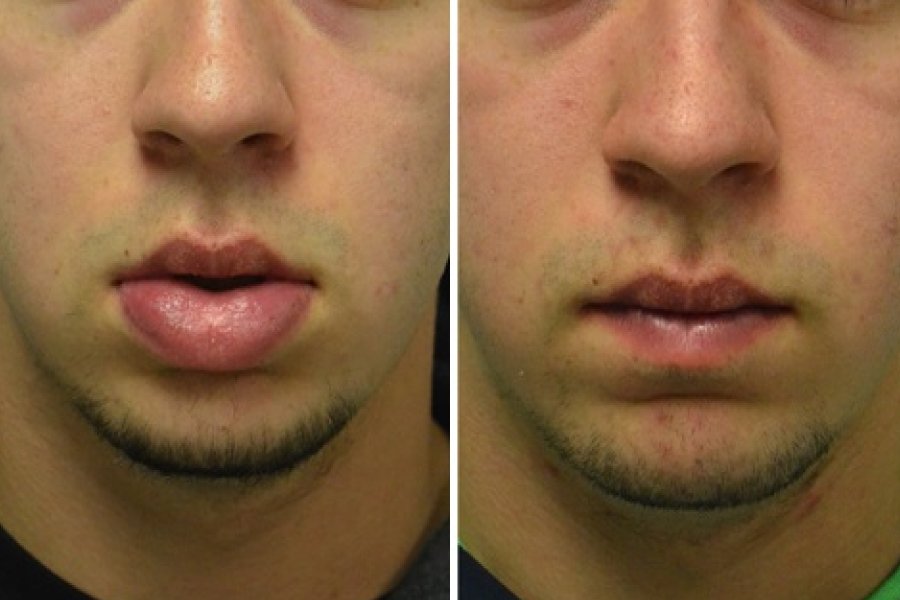 Lip Reduction