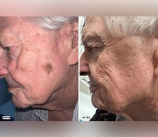 Seborrheic Keratosis Remedies for Older Adults and safe skin treatment options