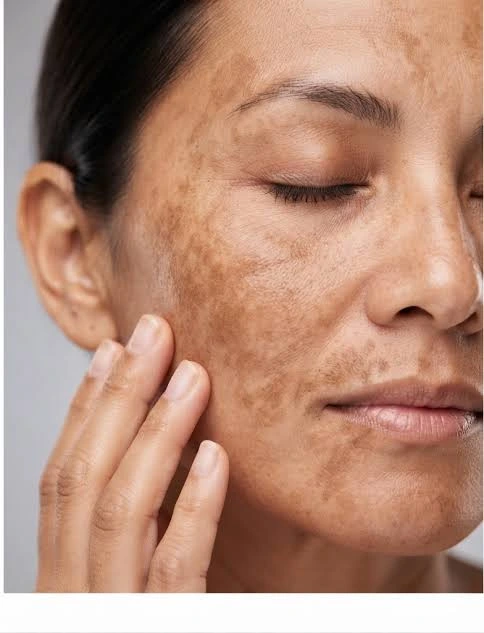 What Causes Melasma to Need Treatment