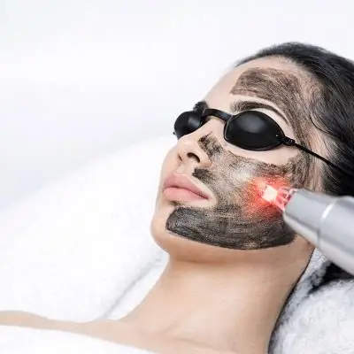 What Happens During Laser Carbon Peel Treatment
