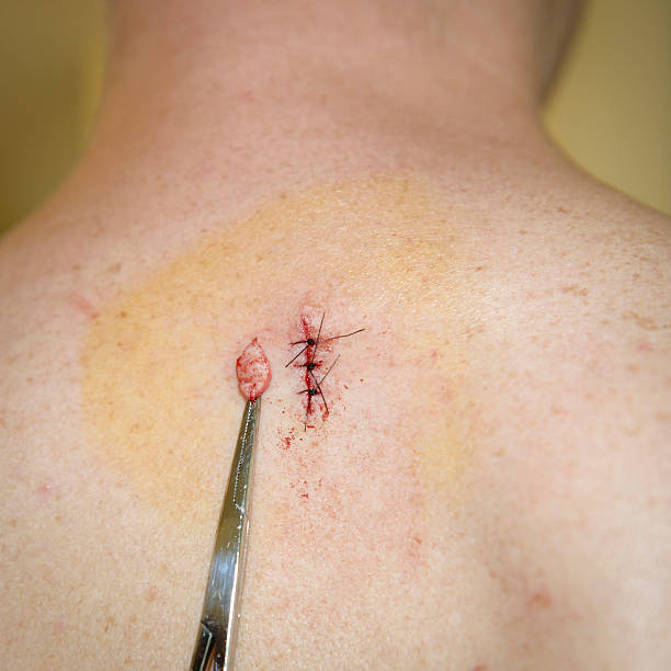 What Makes Skin Lesion Removal a Treatment Option