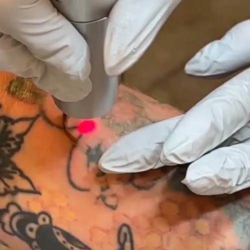 What factors affect Laser Tattoo Removal results