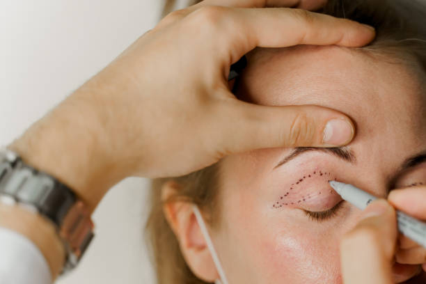 What should you know before considering Eyelid Surgery
