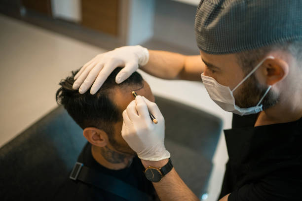 What should you know before getting a Hair Transplant