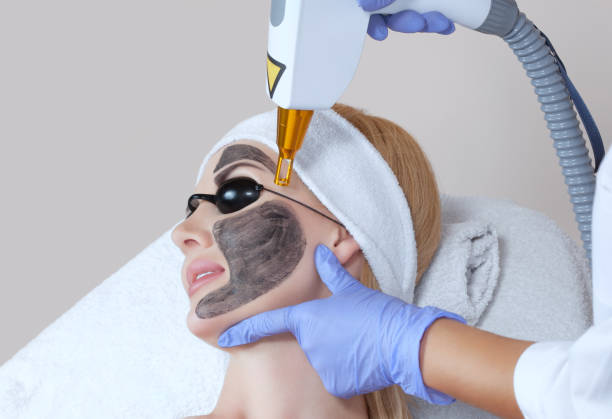 What skin concerns can Laser Carbon Peel help improve?