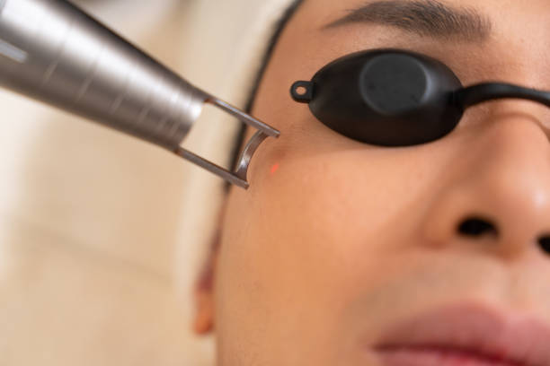 Who Is Really an Ideal Candidate for CO2 Laser Treatment